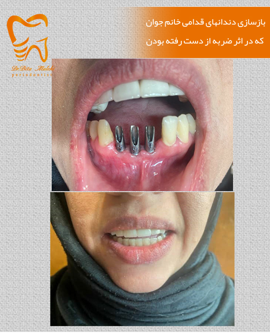 دندانهای قدامی