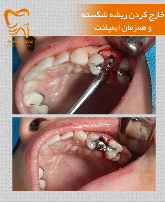 جراحی دندان شکسته
