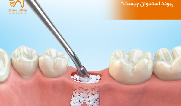 پیوند استخوان