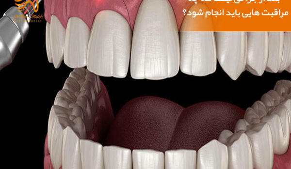 جراحی لیفت لثه