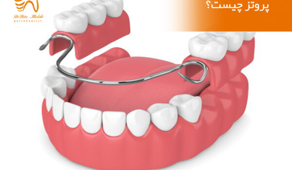 ایمپلنت و پروتز