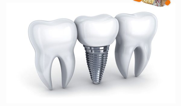 پیچ ایمپلنت دکتر بیتا ملکی